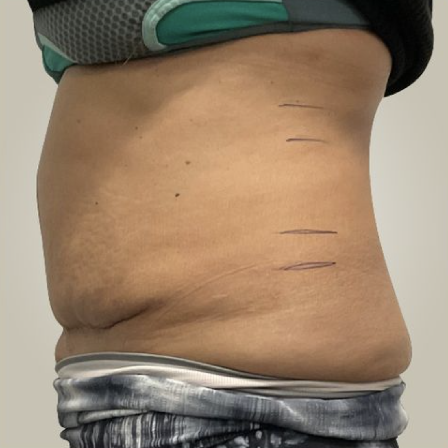 Abdomen, postpartum Before