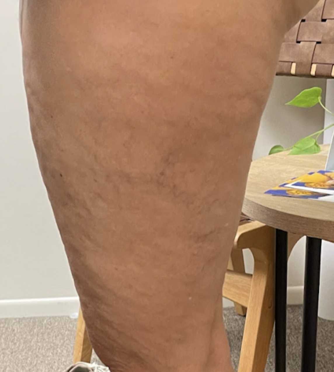Thighs After