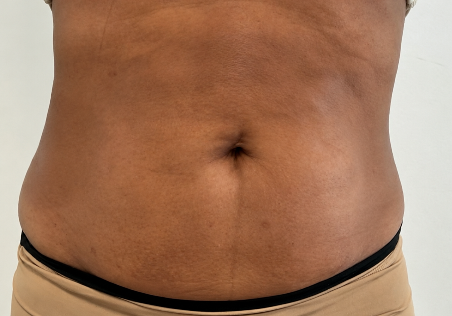 Abdomen After