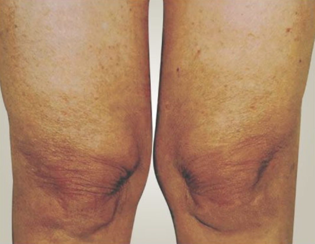 Knees After