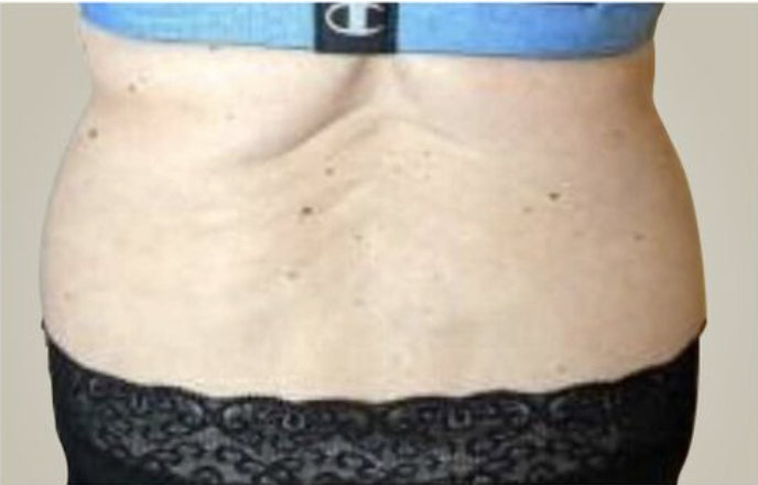Love handles Before