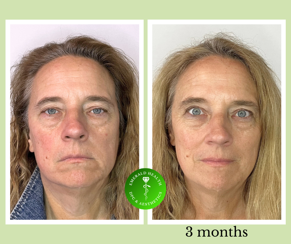 Emerald Health DPC and Aesthetics patient before and 3 months after NeoGen nitrogen plasma treatment