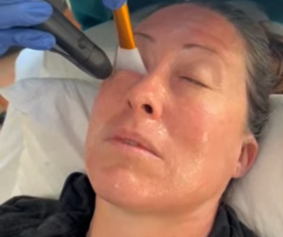 Live NeoGen nitrogen plasma application on delicate eyelid and peri-orbital area