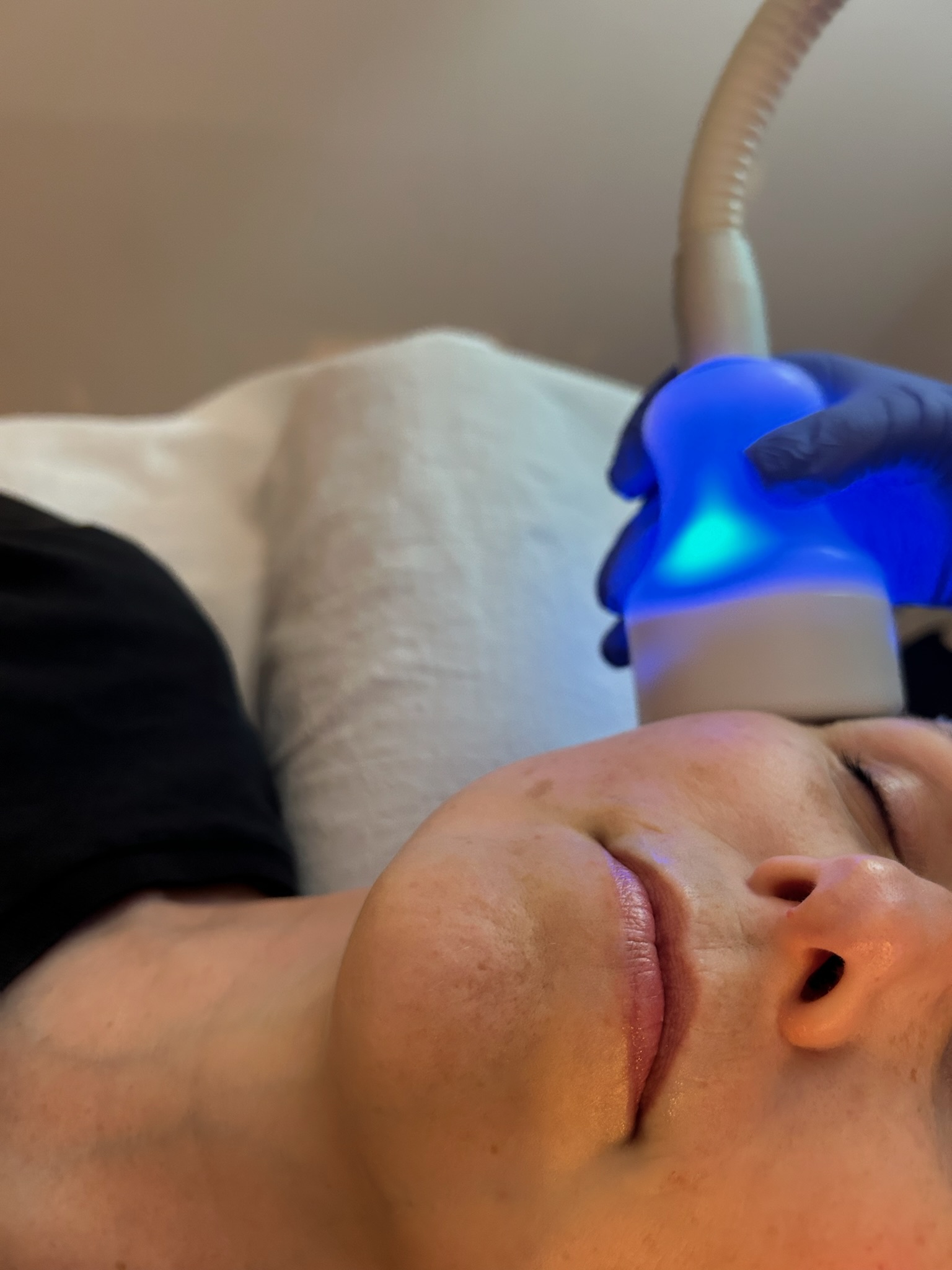 Neveskin cold facial treatment in progress