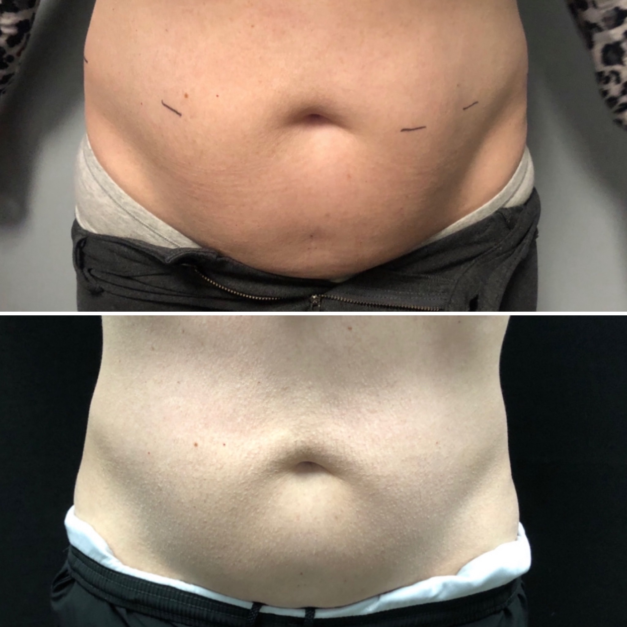 Neveskin slimming before and after transformation