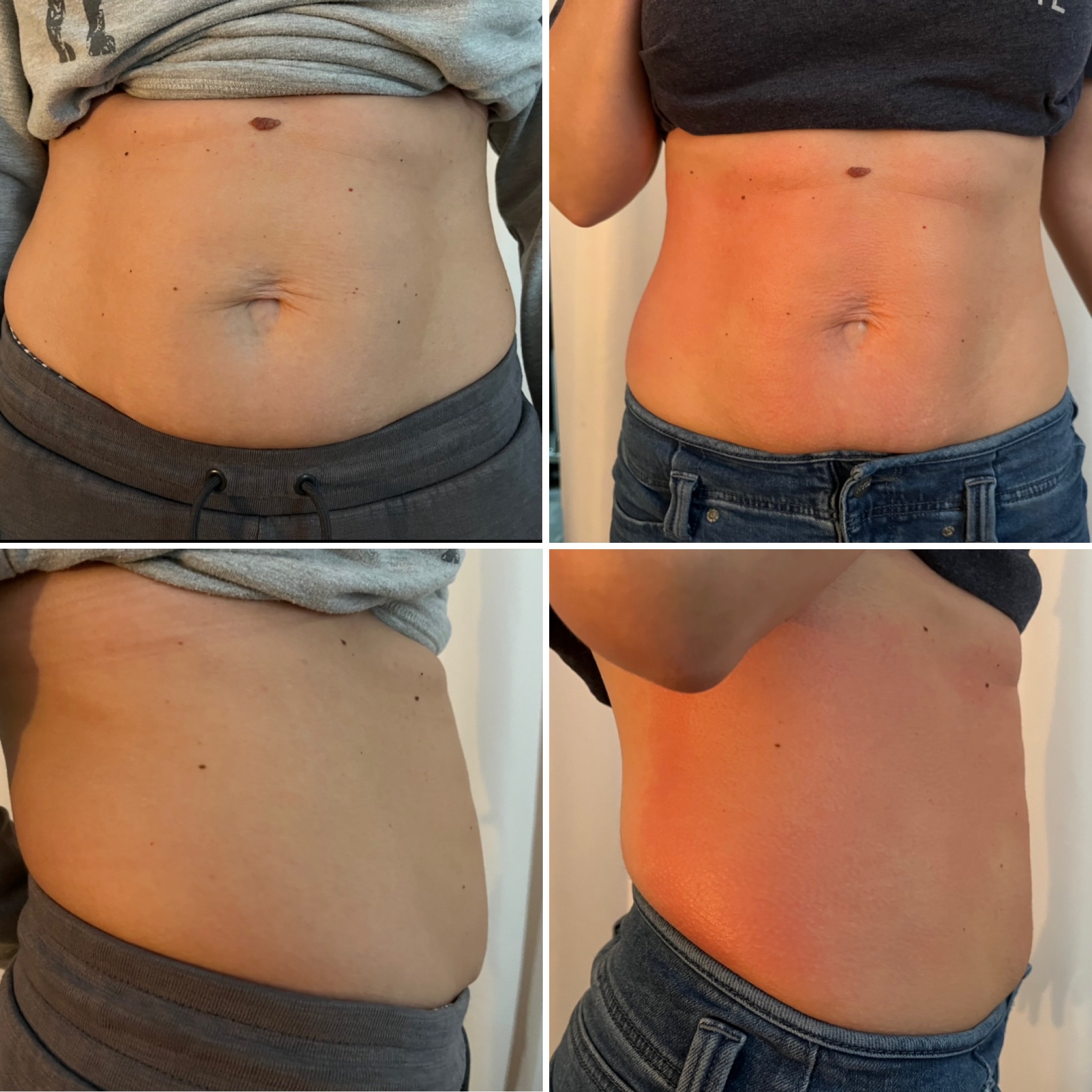 Neveskin body contouring before and after results