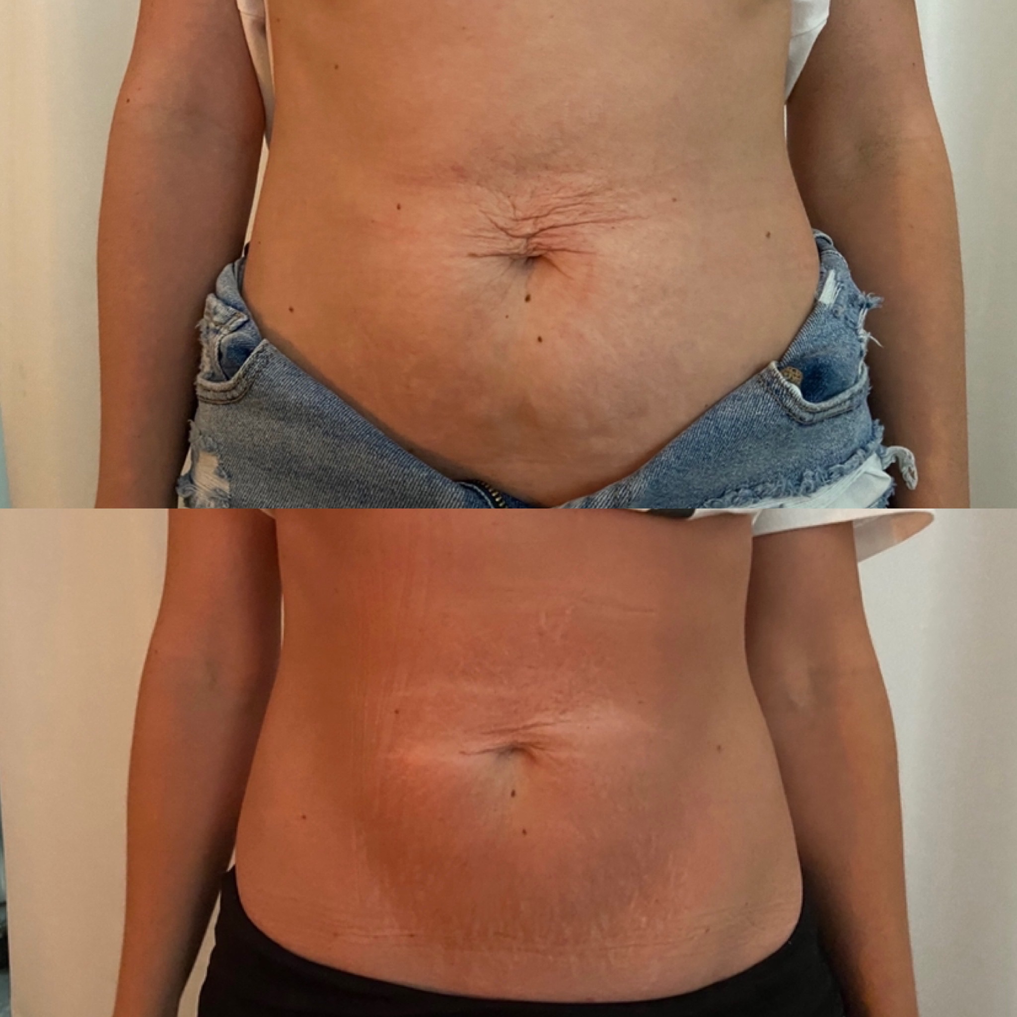 Neveskin skin toning and tightening before and after results
