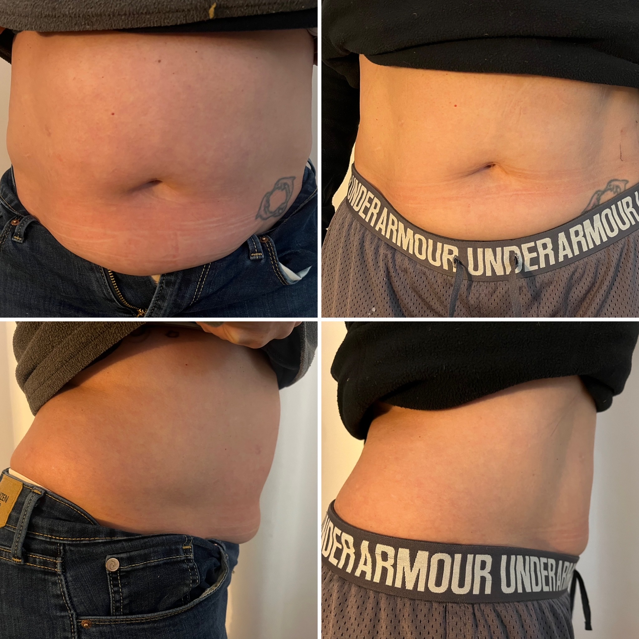 Neveskin slimming and contouring before and after results