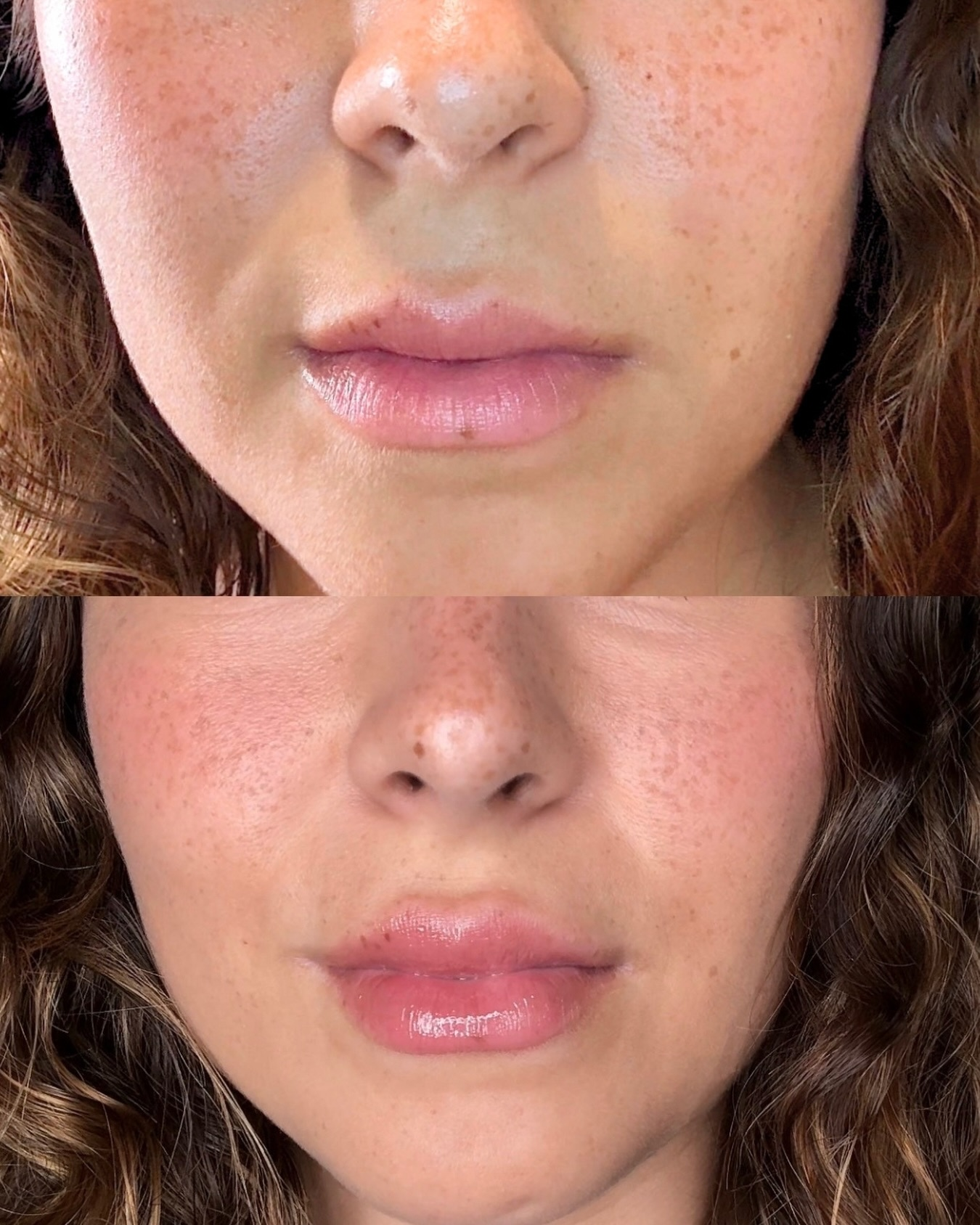 Before and After lip filler showing symmetry correction and natural proportions