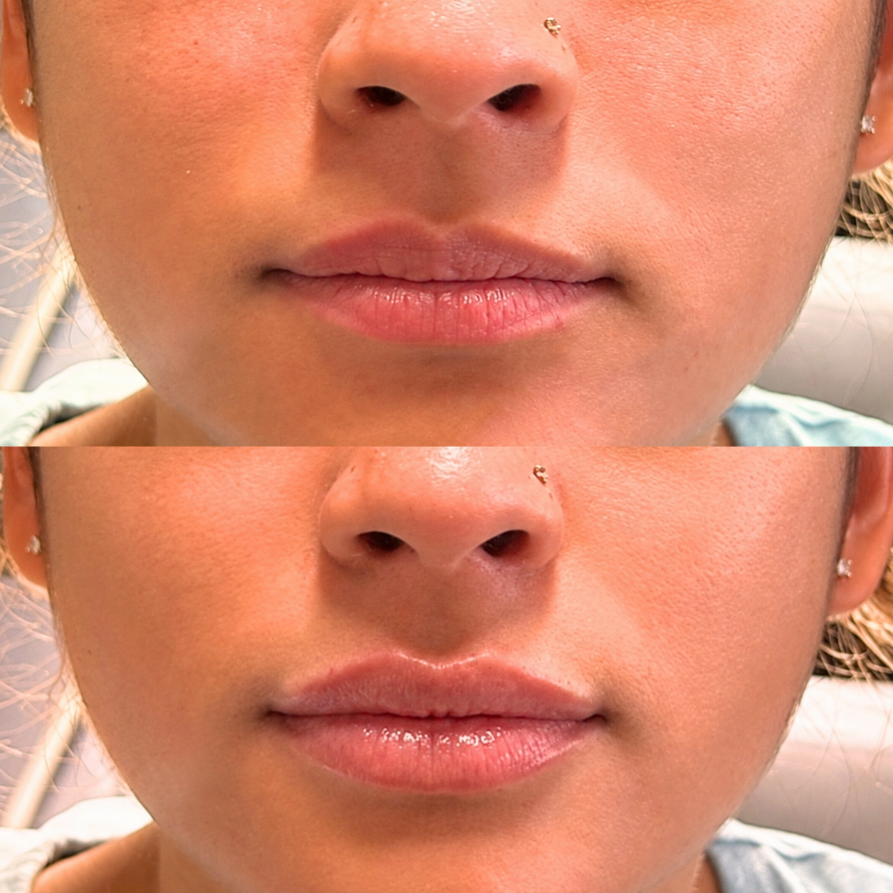 Before and After lip filler showing subtle vertical definition and balanced shape
