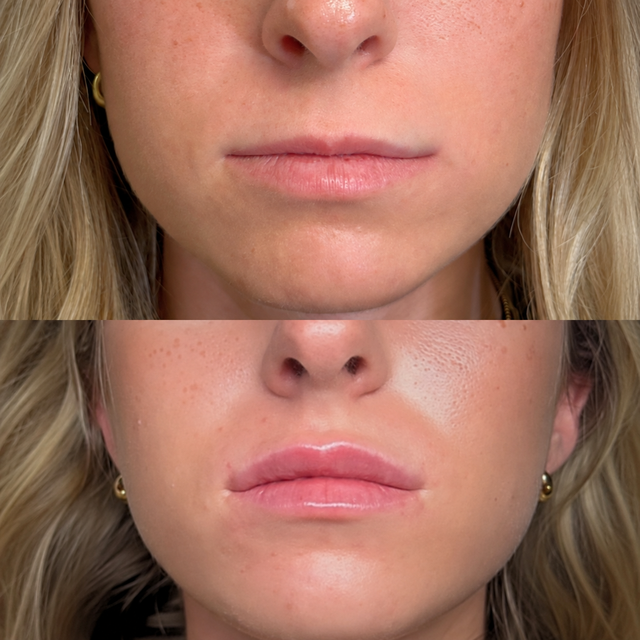 Before and After lip filler result showing natural shape and balanced volume