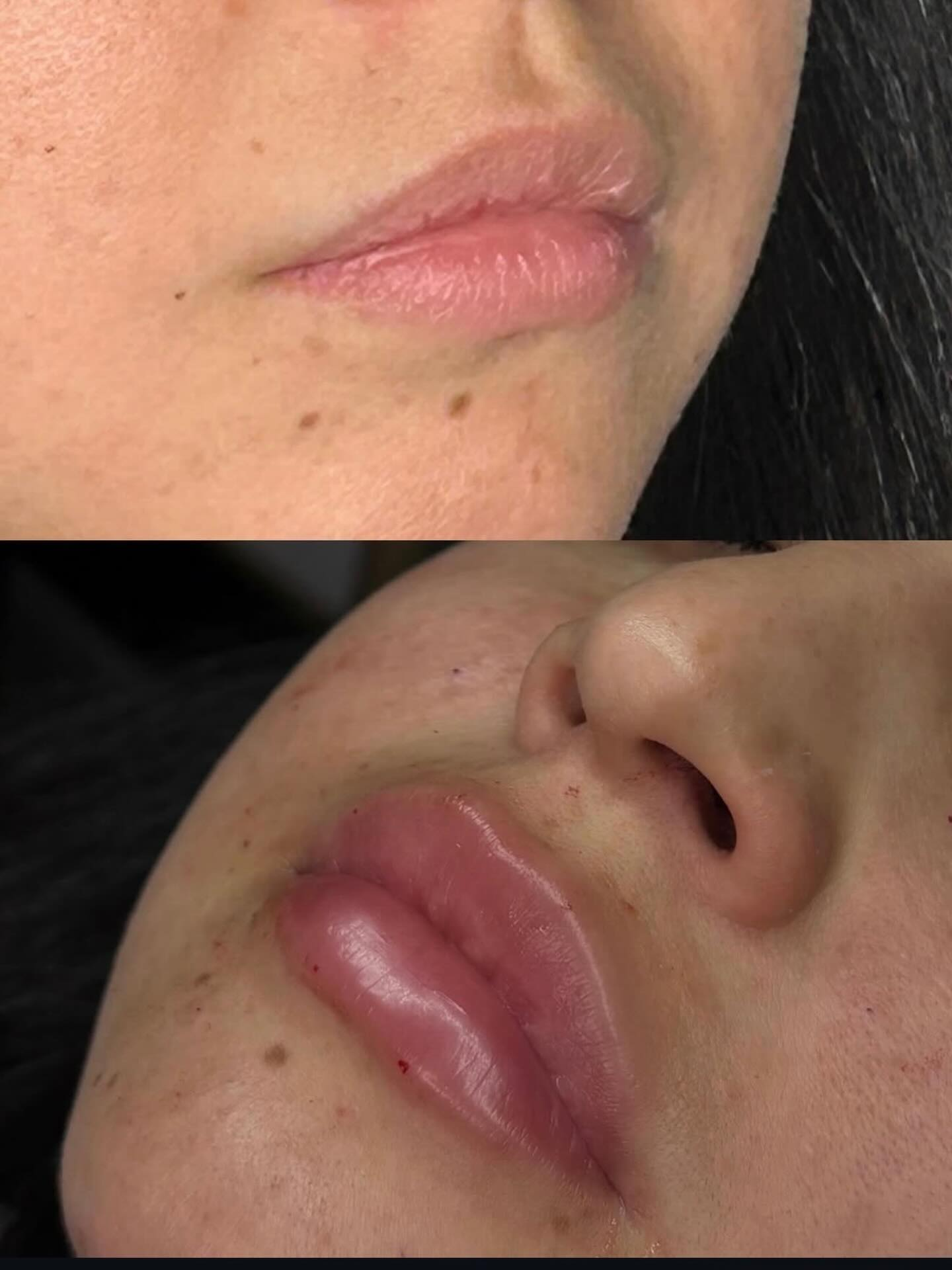 Before and After lip filler angled profile result