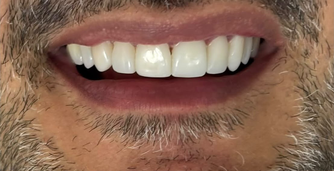Después — Diseño de sonrisa en cerómero