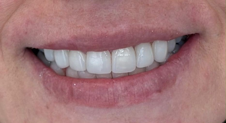 Después — Diseño de sonrisa en cerómero