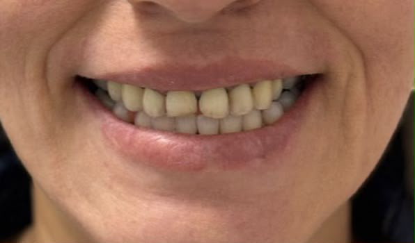 Antes — Diseño de sonrisa en cerómero