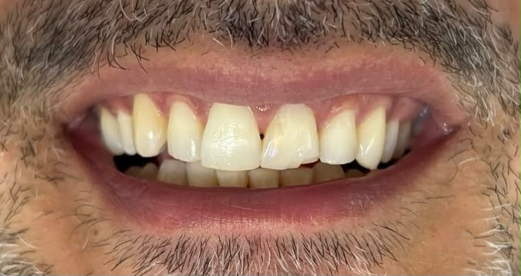 Antes — Diseño de sonrisa en cerómero