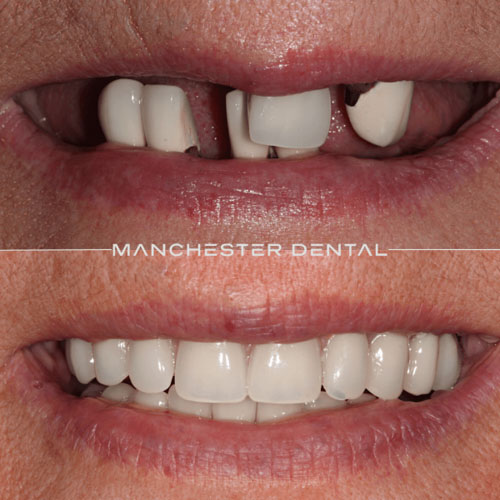 Implant-Supported Ceramic Bridge — real patient result at Manchester Dental
