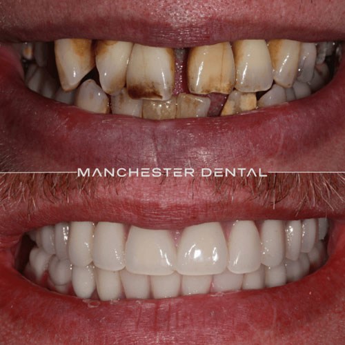 Fixed Full Arch Implant Prosthesis — real patient result at Manchester Dental