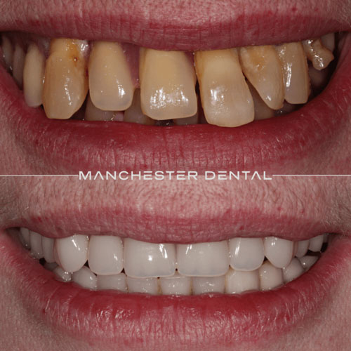 Full Arch Ceramic & Implant Bridge — real patient result at Manchester Dental