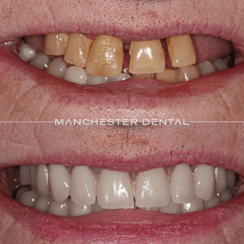 Full Arch Fixed Implant Restoration — real patient result at Manchester Dental