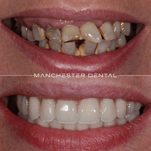 Implant Bridge & Ceramic Reconstruction — real patient result at Manchester Dental