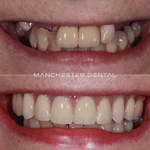 Fixed Dental Implants & Ceramic Crowns — real patient result at Manchester Dental