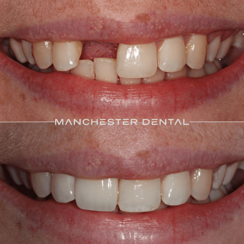 Single Tooth Titanium Implant — real patient result at Manchester Dental
