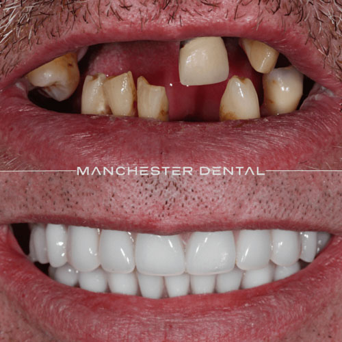 Fixed Full Arch Implant Restoration — real patient result at Manchester Dental