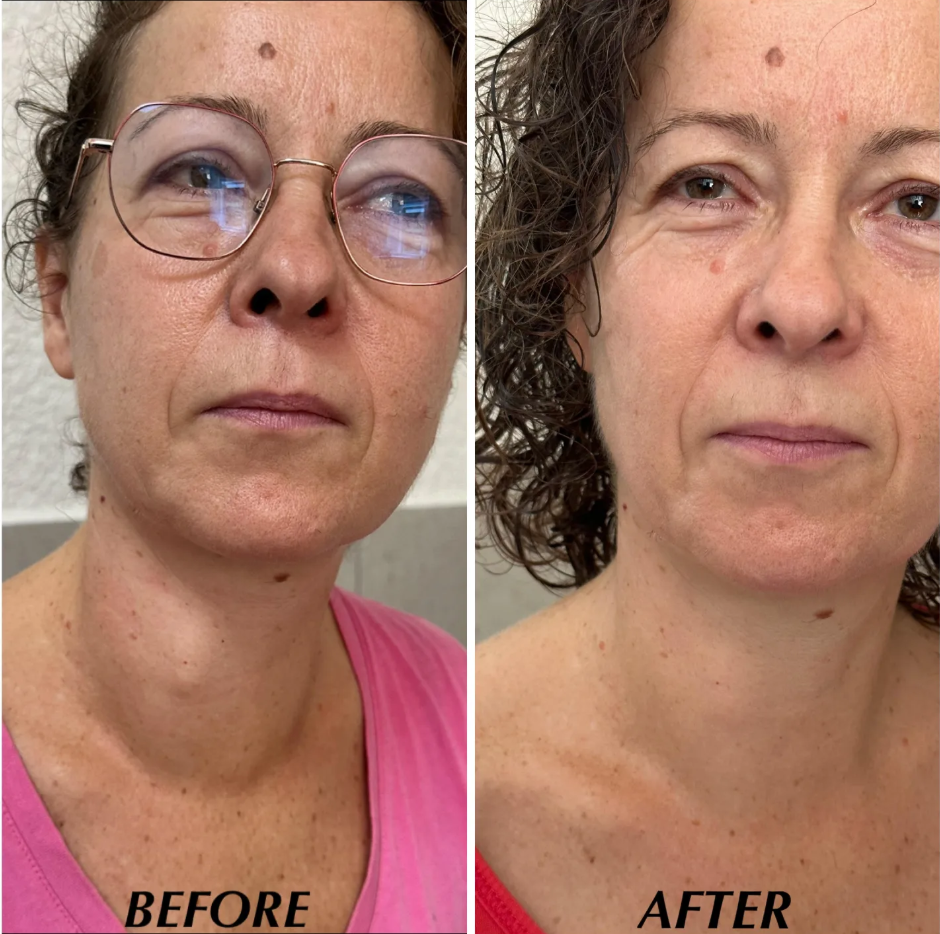 Before and after clinical observation of thyroid goiter reduction under Ayurvedic care