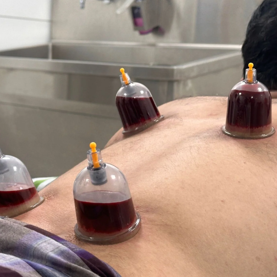 Traditional cupping therapy session