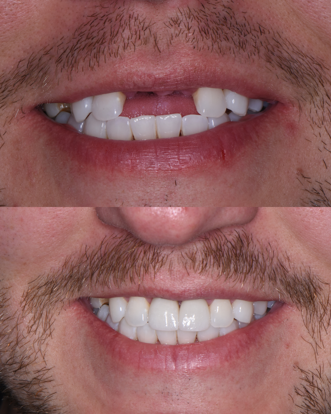 Before and after dental implant treatment restoring confidence and smile