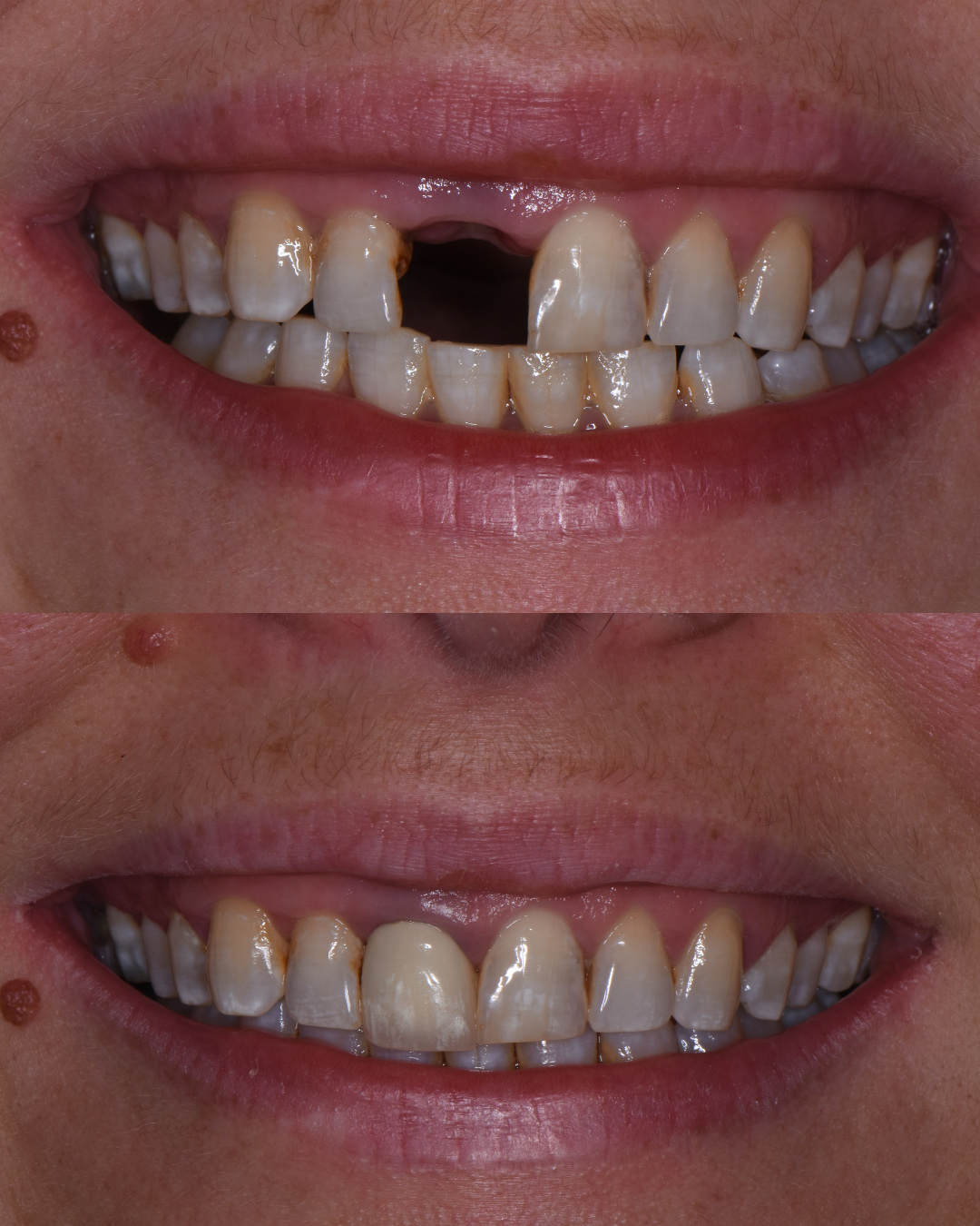 Before and after single dental implant replacing missing front tooth