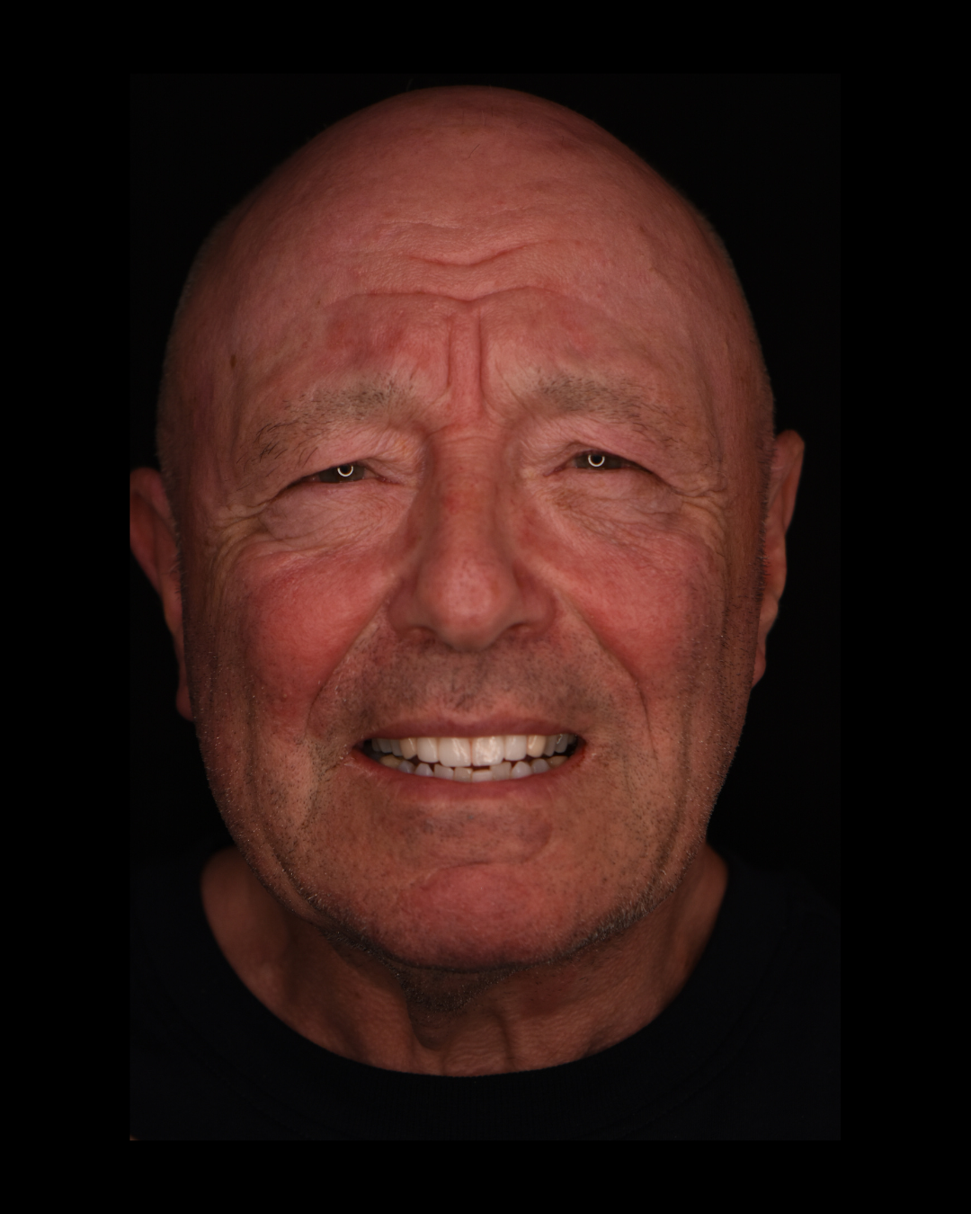 After dental implant treatment: restored, even smile