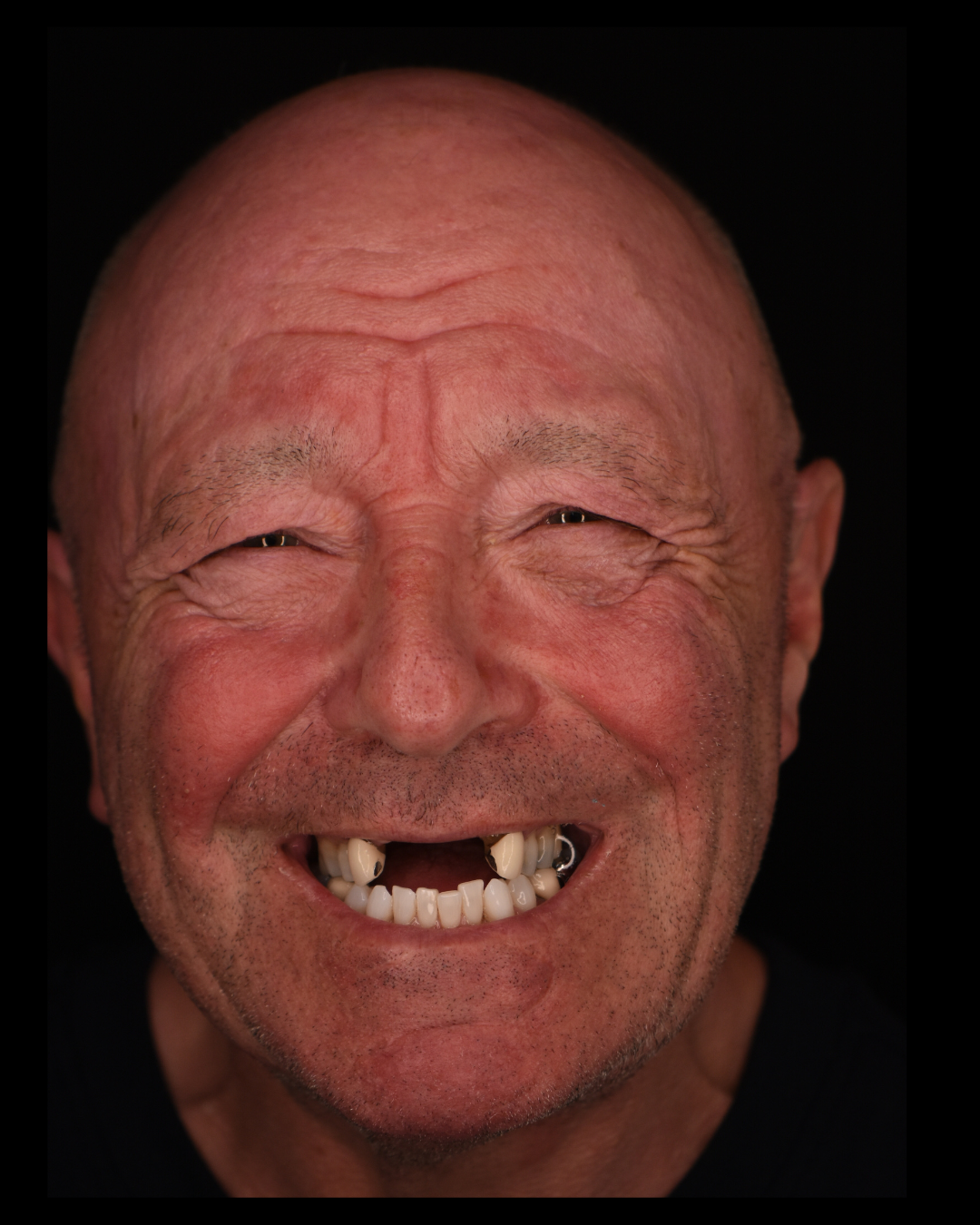 Before dental implant treatment: missing and worn teeth