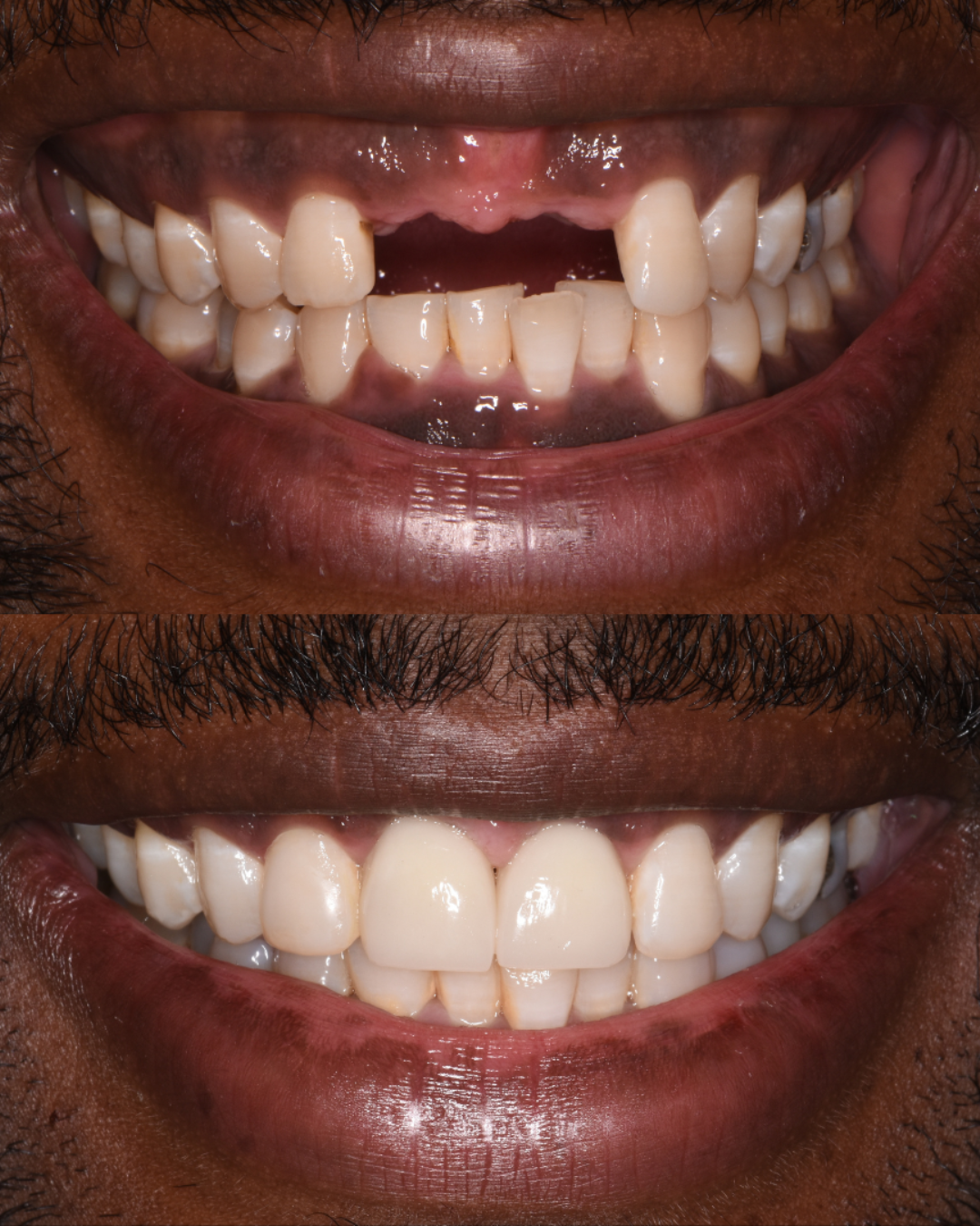 Before and after dental implant restoration showing restored upper teeth