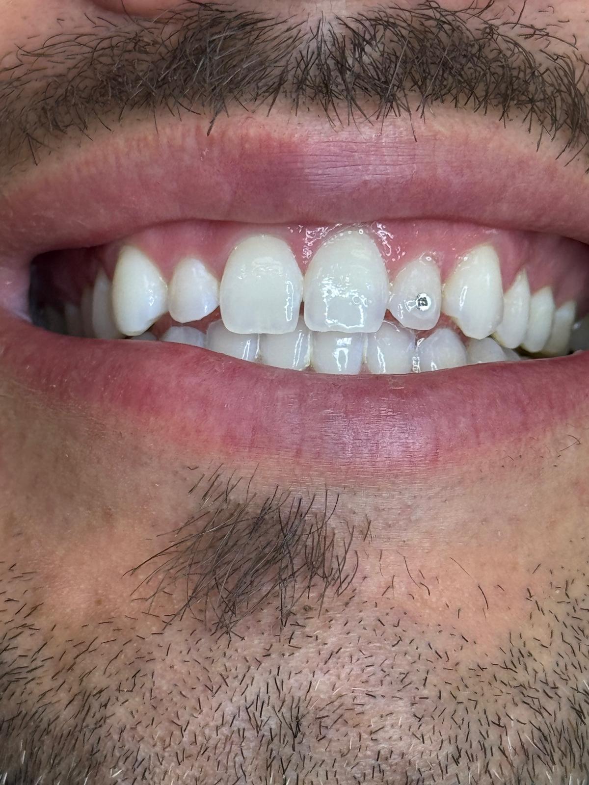 Classic single tooth gem style