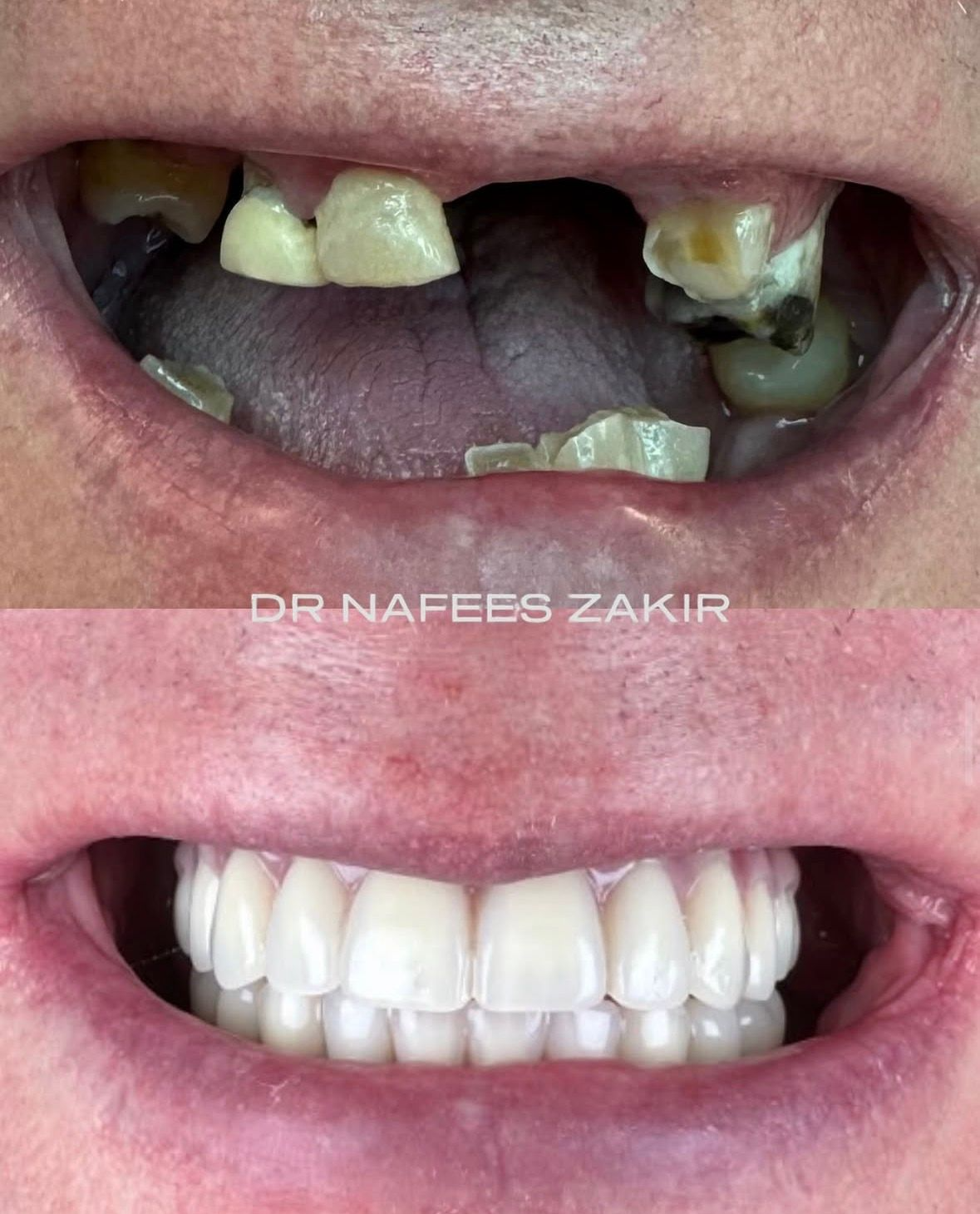 Extensive Tooth Loss to Natural Harmonised Smile Line