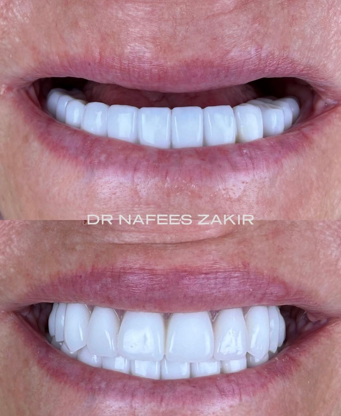 Collapsing Vertical Dimension & Periodontal Breakdown