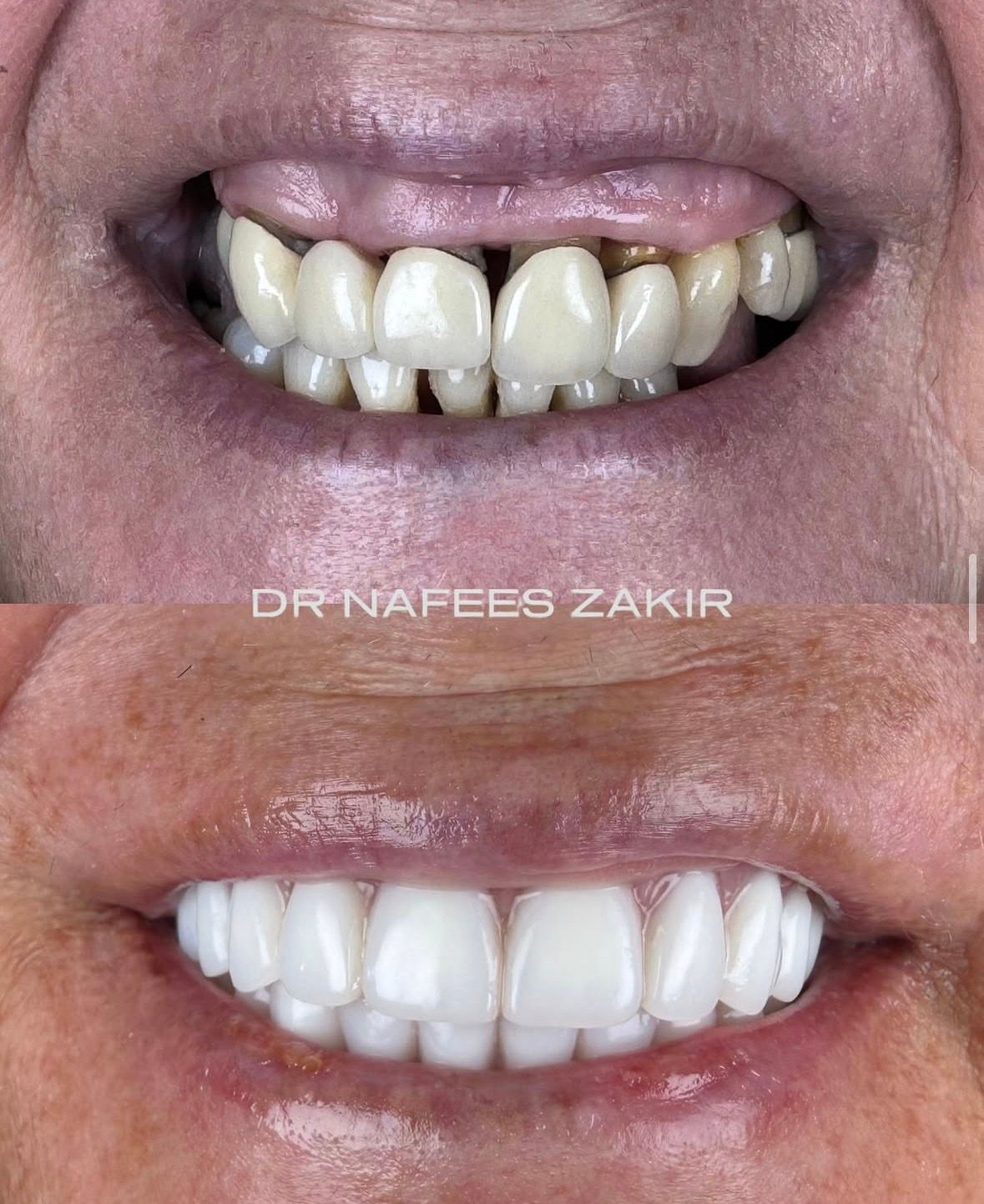 Atrophic Arch & Residual Dentition to High-Aesthetic Smile
