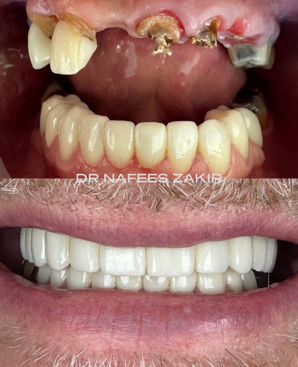 Severe Maxillary Breakdown to Full Immediate Rehabilitation