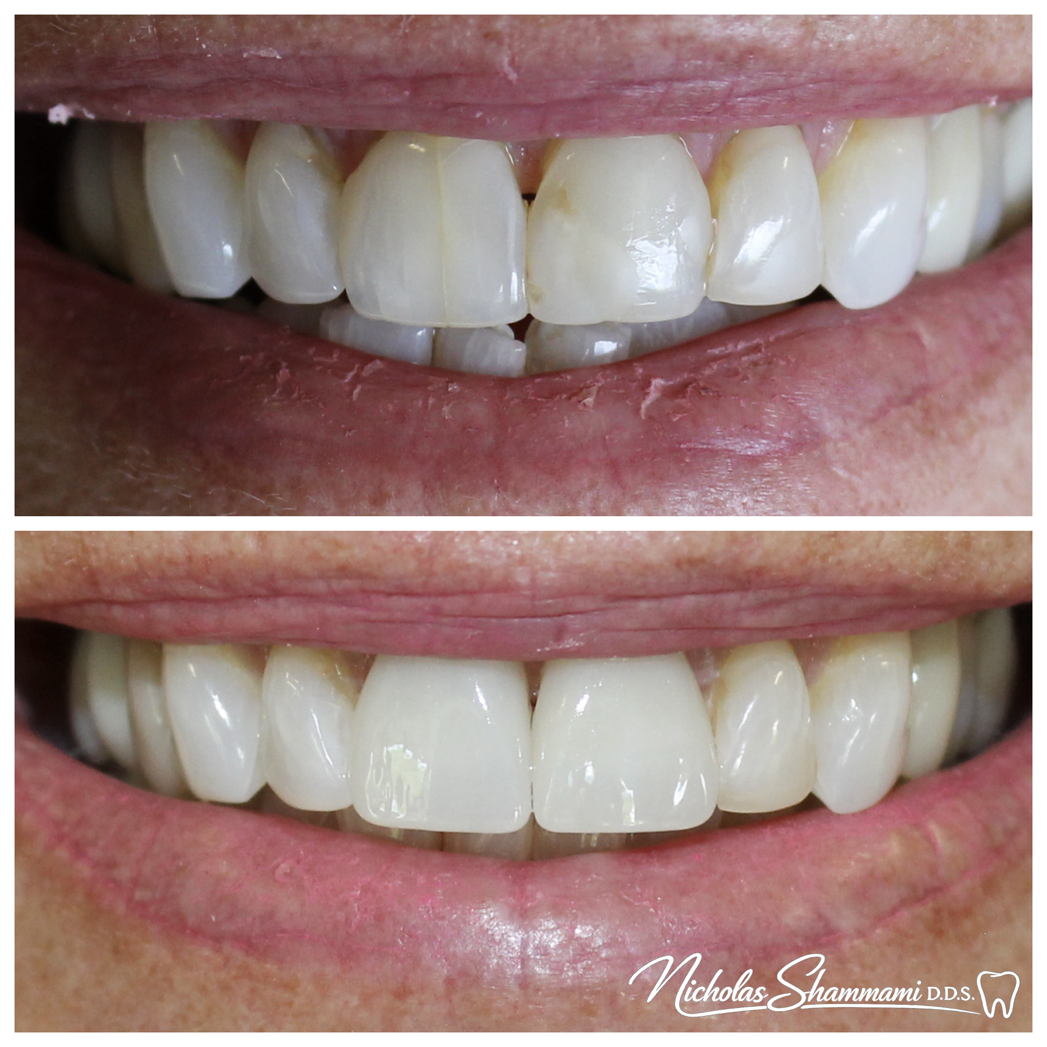 Two Crowns for Fracture Lines & Discoloration - Before and After by Nicholas Shammami, DDS