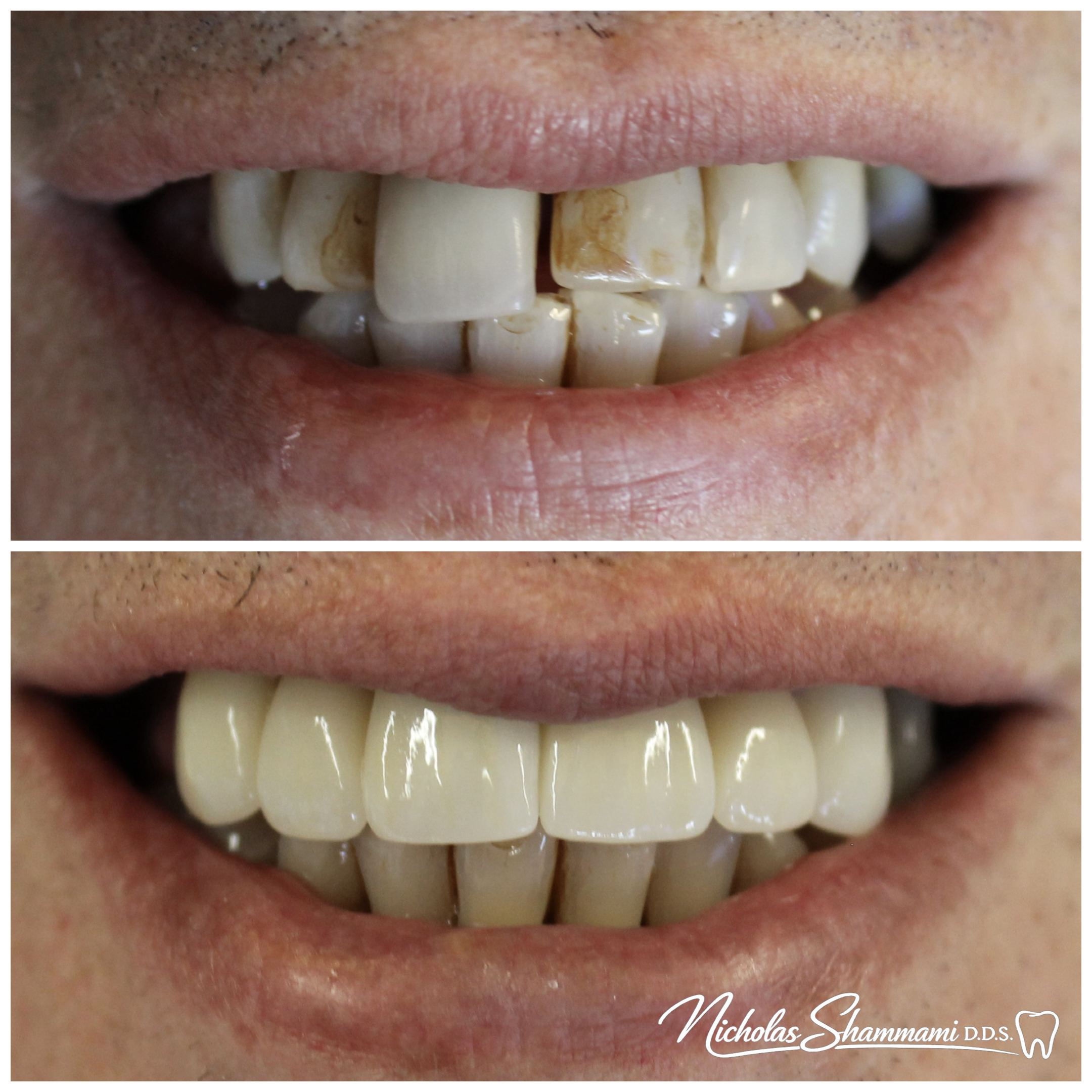 Anterior Diastema Closure — Crowns & Veneers - Before and After by Nicholas Shammami, DDS