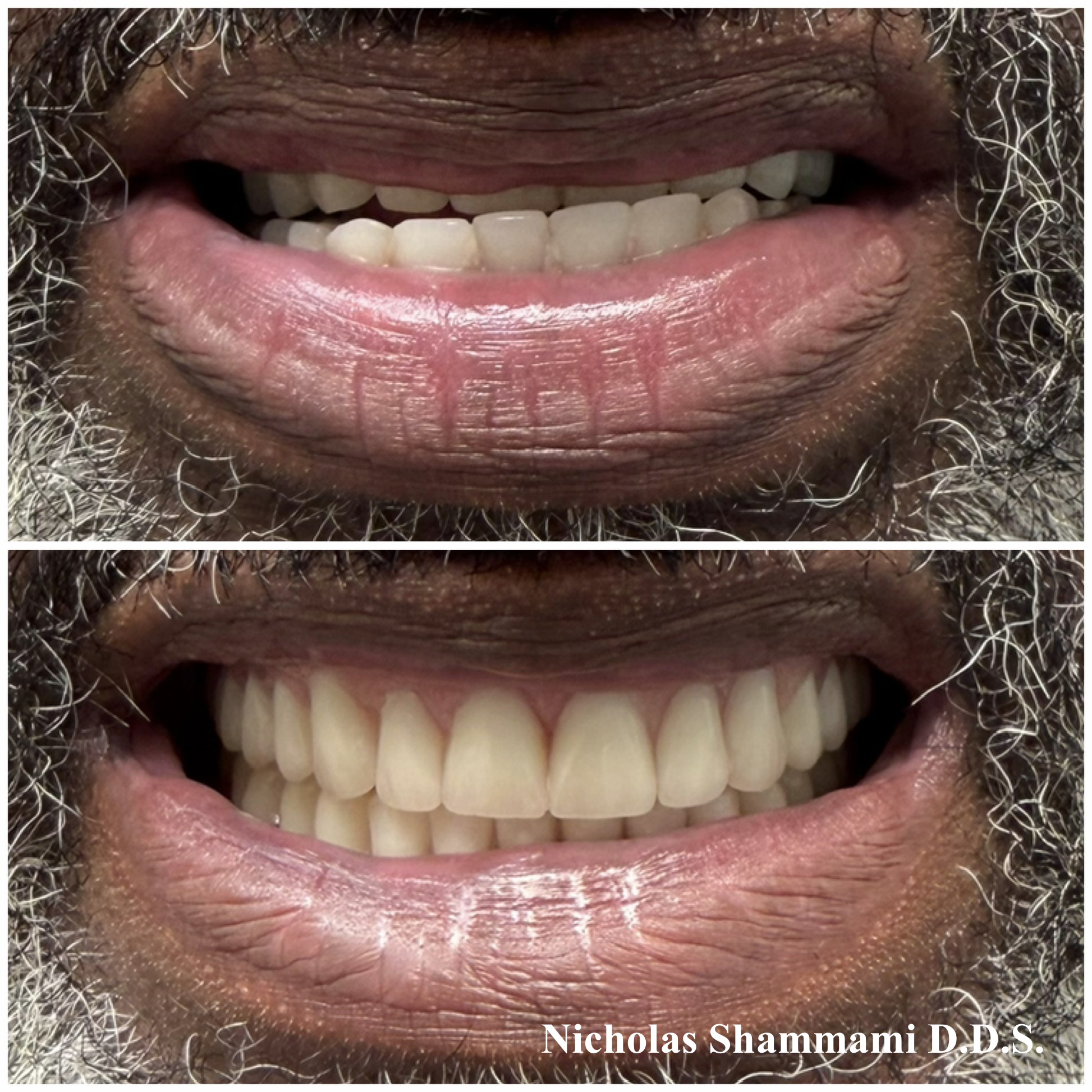 Denture Replacement for a Collapsed Bite - Before and After by Nicholas Shammami, DDS