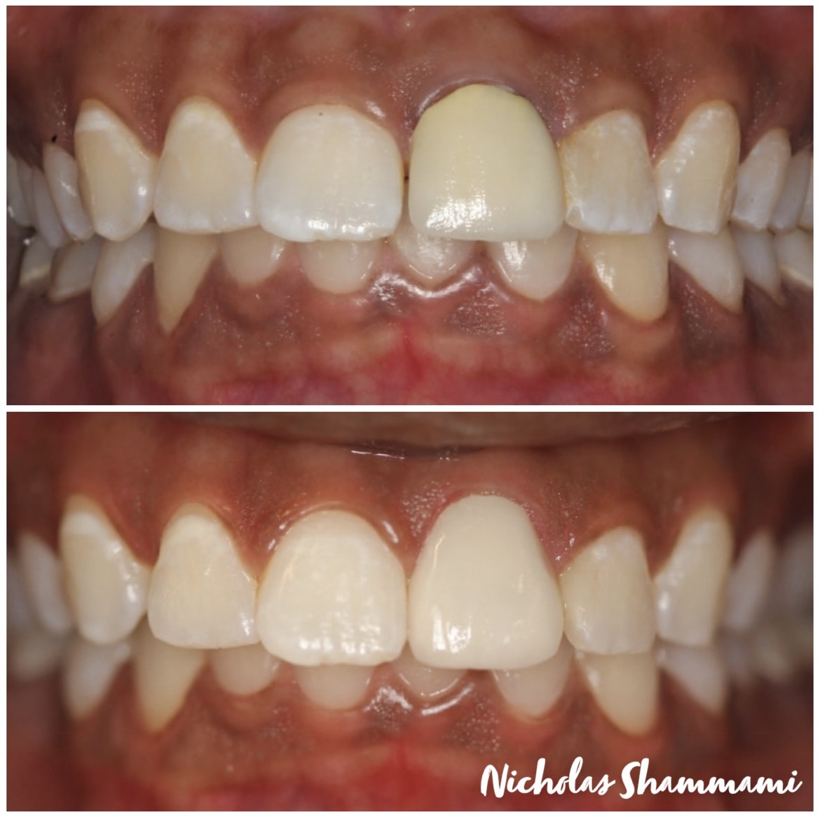 Single Tooth Crown Revision & Shade Harmony - Before and After by Nicholas Shammami, DDS