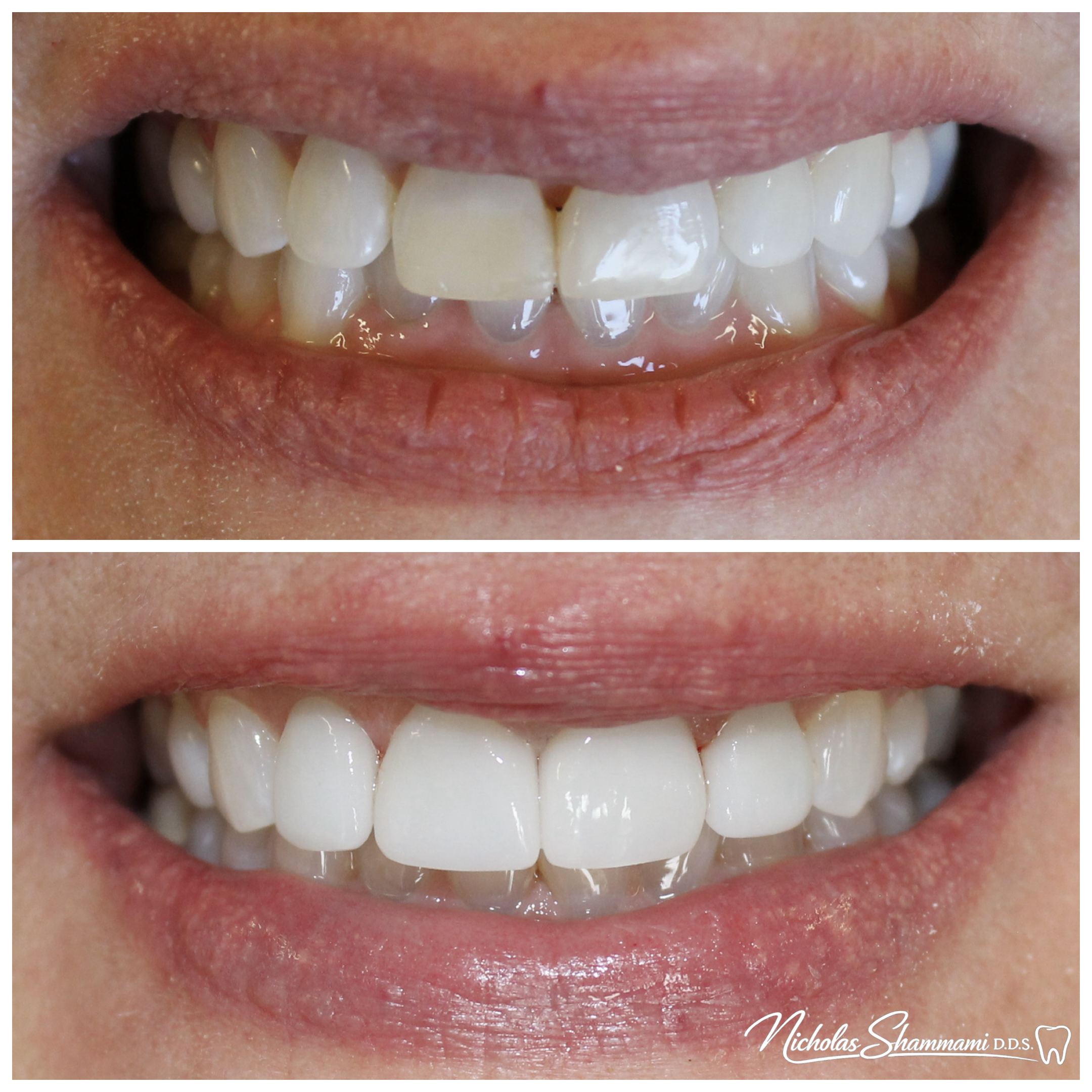 Veneers Replacing Stained Bonding & Black Triangle - Before and After by Nicholas Shammami, DDS