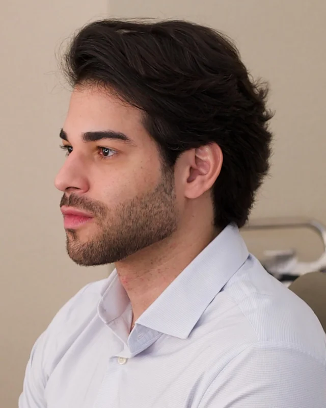 Antes e depois de projeto de visagismo masculino realizado por Victor Marins — Linha Frontal & Mandíbula, depois