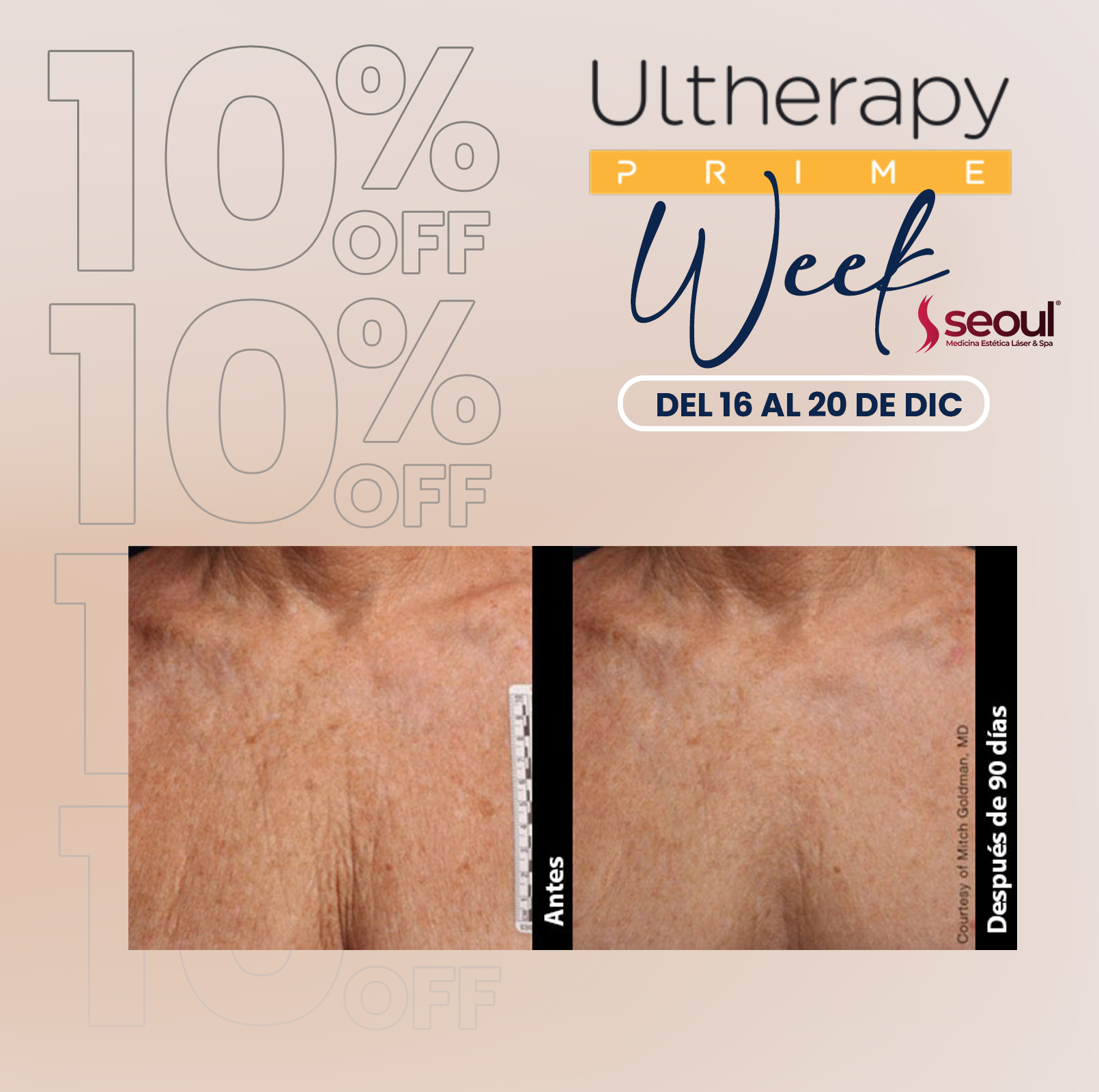 Caso clínico antes y después en Escote con Ultherapy PRIME