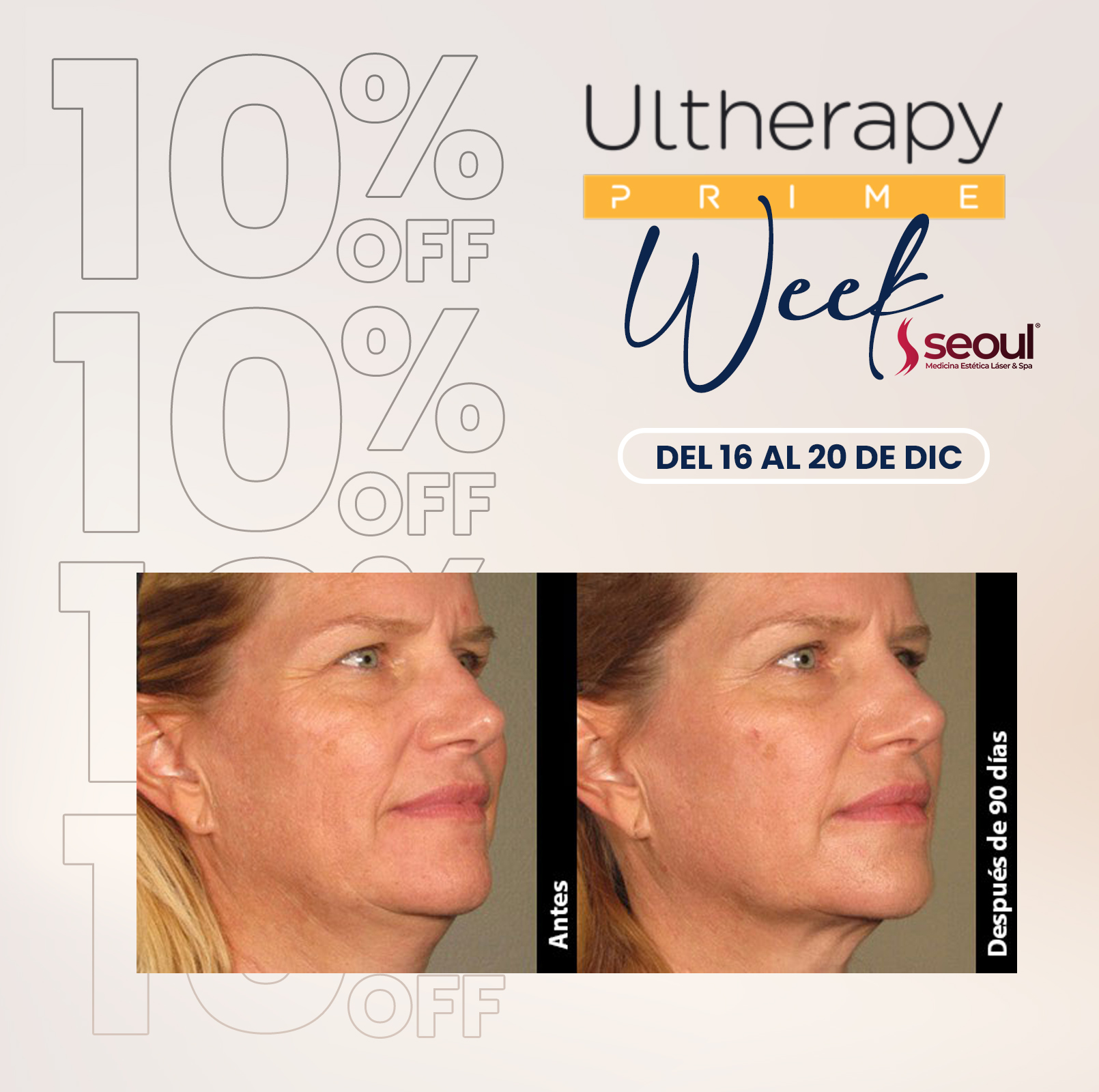 Caso clínico antes y después en Rostro Completo con Ultherapy PRIME