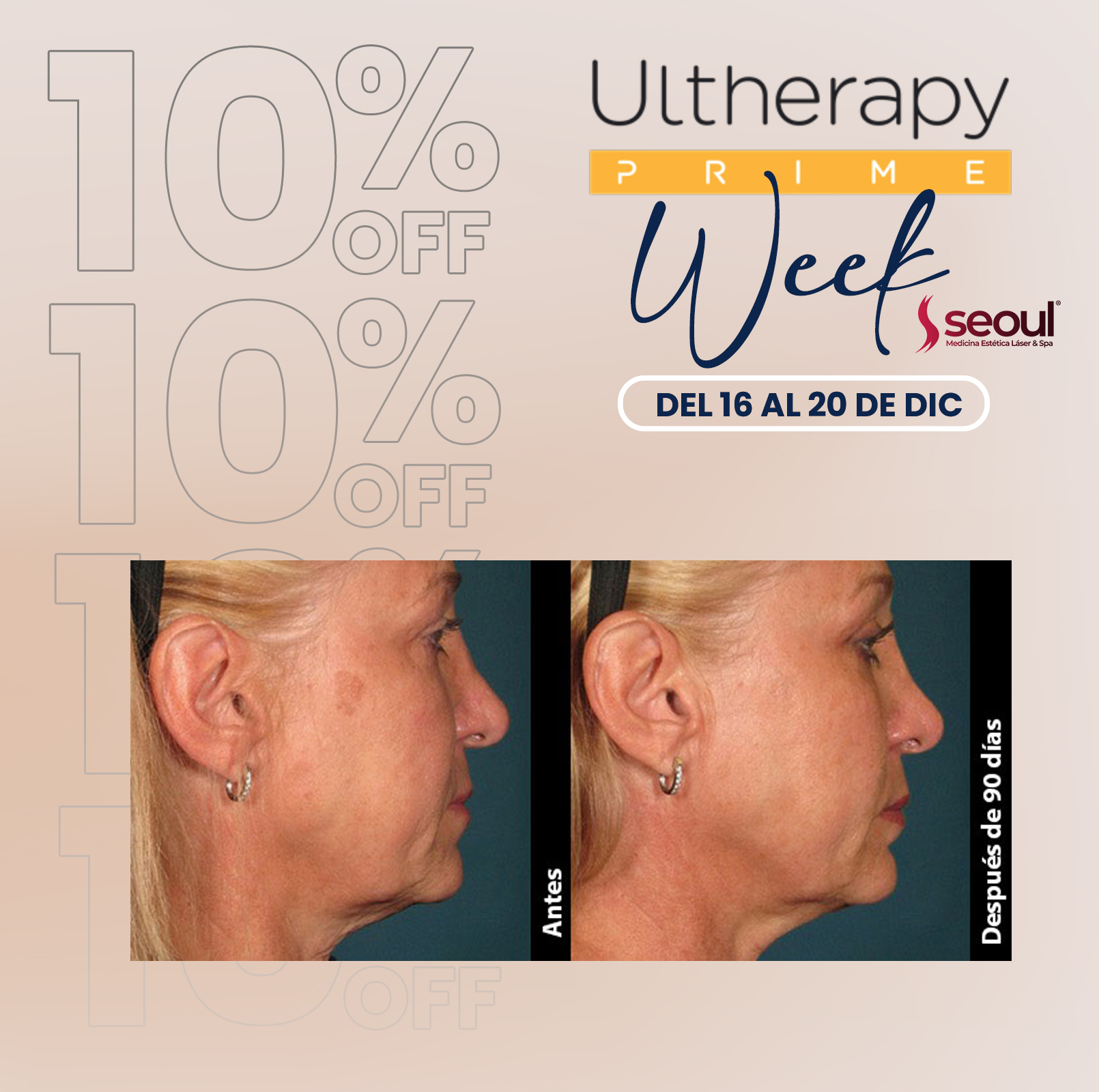 Caso clínico antes y después en Contorno Mandibular con Ultherapy PRIME