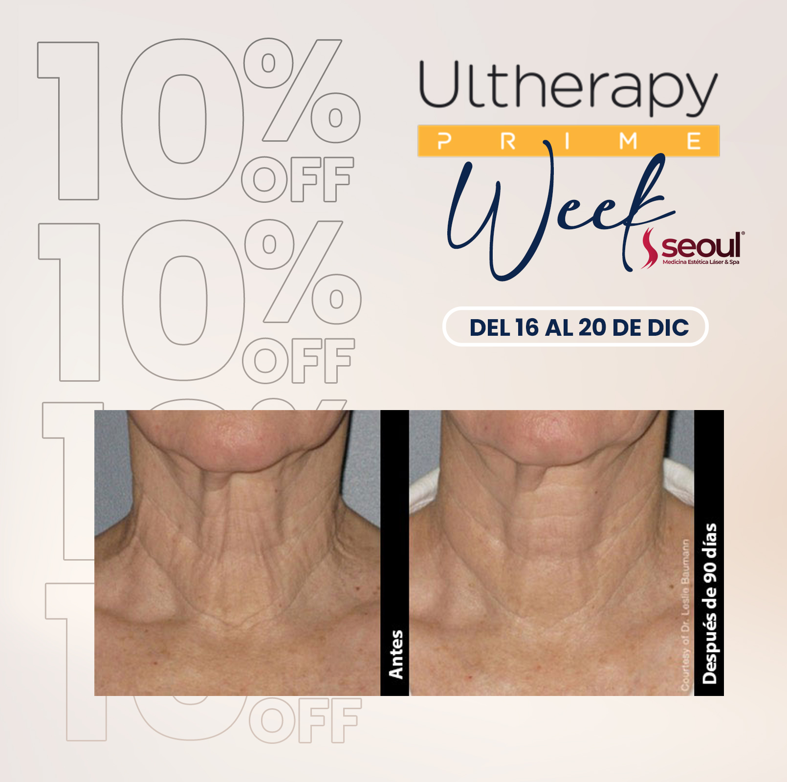 Caso clínico antes y después en Cuello con Ultherapy PRIME